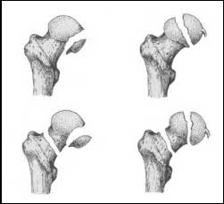 fratura femural